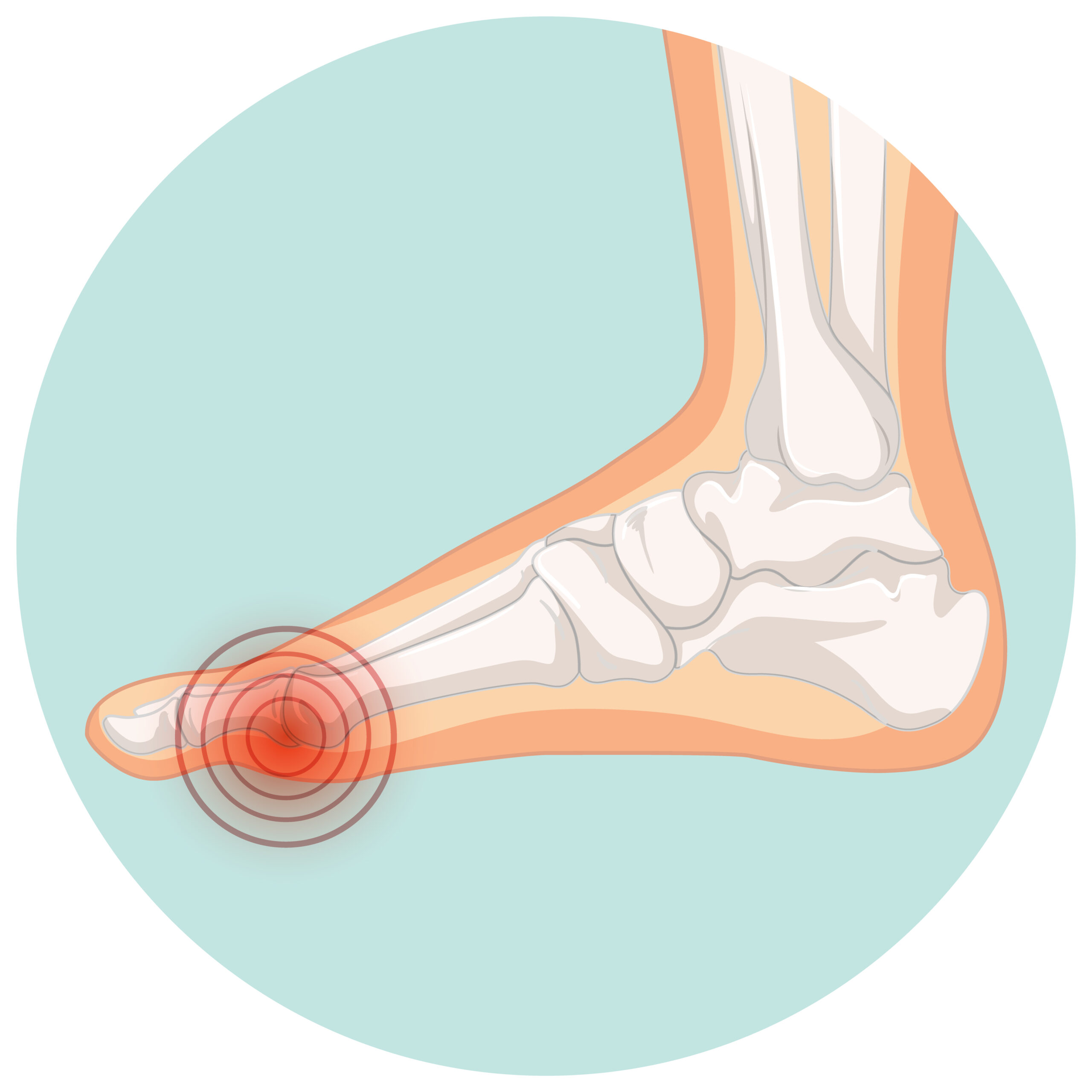 Hallux valgus – Hilfe für die Füße